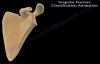 Scapular Fracture Classification Animation  Everything You Need To Know  Dr. Nabil Ebraheim