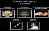 Spinal Cord Injury  Paralysis  Everything You Need To Know  Dr. Nabil Ebraheim