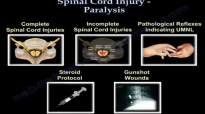 Spinal Cord Injury  Paralysis  Everything You Need To Know  Dr. Nabil Ebraheim