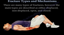 Fractures, Types And Mechanisms  Everything You Need To Know  Dr. Nabil Ebraheim