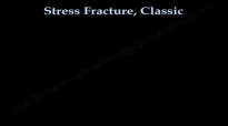 Stress Fracture, Classic  Everything You Need To Know  Dr. Nabil Ebraheim