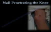 Nail Penetrating the Knee  Everything You Need To Know  Dr. Nabil Ebraheim