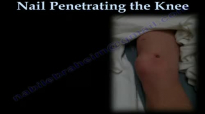 Nail Penetrating the Knee  Everything You Need To Know  Dr. Nabil Ebraheim