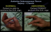 Anterior Interosseous Nerve Injury Classic  Everything You Need To Know  Dr. Nabil Ebraheim