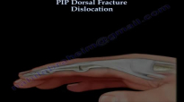 PIP Dorsal Fracture Dislocation  Everything You Need To Know  Dr. Nabil Ebraheim
