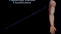 Capitellum Fracture Classification  Everything You Need To Know  Dr. Nabil Ebraheim