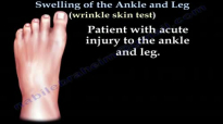 Swelling Of The Ankle and Leg ,Wrinkle Test  Everything You Need To Know  Dr. Nabil Ebraheim