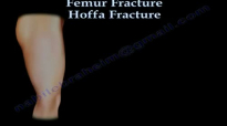 Hoffa Fracture  Everything You Need To Know  Dr. Nabil Ebraheim