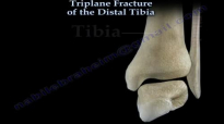 Triplane Fracture Of The Distal Tibia  Everything You Need To Know  Dr. Nabil Ebraheim