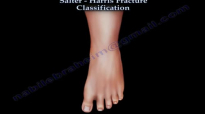 Salter Harris Fracture Classification  Everything You Need To Know  Dr. Nabil Ebraheim
