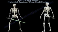 Nightstick Fracture , Ulnar Shaft fracture  Everything You Need To Know  Dr. Nabil Ebraheim