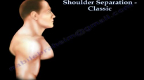 Shoulder Separation, Classic  Eveything You Need To Know  Dr. Nabil Ebraheim