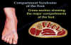 Foot Compartment Syndrome  Everything You Need to Know  Dr. Nabil Ebraheim