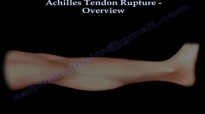 Achilles Tendon Rupture Overview  Everything You Need To Know  Dr. Nabil Ebraheim