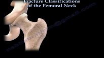 Femoral Neck Classifications  Everything You Need To Know  Dr. Nabil Ebraheim