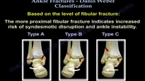 Ankle Fractures Danis Weber Classification  Everything You Need To Know  Dr. Nabil Ebraheim