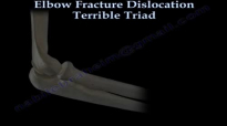 Elbow Fracture Dislocation Terrible Triad  Everything You Need To Know  Dr. Nabil Ebraheim