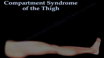 Thigh Compartment Syndrome  Everything You Need To Know  Dr. Nabil Ebraheim