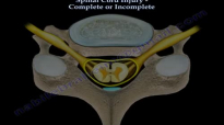 Spinal Cord Injury Complete Or Incomplete  Everything You Need To Know  Dr. Nabil Ebraheim