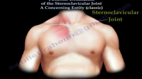 Posterior Dislocation Sternoclavicular ClassicEverything You Need To Know  Dr. Nabil Ebraheim
