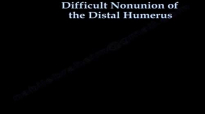Difficult Nonunion Of The Distal Humerus  Everything You Need To Know  Dr. Nabil Ebraheim