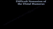 Difficult Nonunion Of The Distal Humerus  Everything You Need To Know  Dr. Nabil Ebraheim