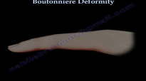 Boutonniere Deformity  Everything You Need To Know  Dr. Nabil Ebraheim