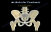 Acetabular Fractures  Everything You Need To Know  Dr. Nabil Ebraheim