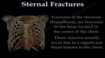 Sternal Fractures  Everything You Need To Know  Dr. Nabil Ebraheim