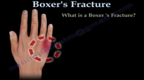 Boxers Fracture  Everything You Need To Know  Dr. Nabil Ebraheim