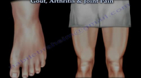Gout, Arthritis & Joint Pain  Everything You Need To Know Dr. Nabil Ebraheim
