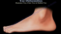Toe Deformities Hammer, Claw & Mallet Toes  Everything You Need To Know  Dr. Nabil Ebraheim