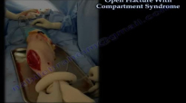 Open Fracture With Compartment Syndrome  Everything You Need To Know  Dr. Nabil Ebraheim
