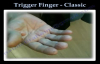 Trigger Finger Classic  Everything You Need To Know  Dr. Nabil Ebraheim