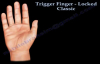 Trigger Finger Locked classic Everything You Need To Know  Dr. Nabil Ebraheim