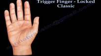 Trigger Finger Locked classic Everything You Need To Know  Dr. Nabil Ebraheim