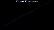 Open Fractures  Everything You Need To Know  Dr. Nabil Ebraheim