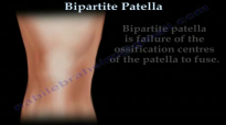 Bipartite Patella  Everything You Need To Know  Dr. Nabil Ebraheim