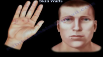 Skin Warts , Hand warts  Everything You Need To Know  Dr. Nabil Ebraheim