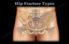 Hip Fractures, Types and fixation  Everything You Need To Know  Dr. Nabil Ebraheim