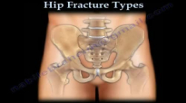Hip Fractures, Types and fixation  Everything You Need To Know  Dr. Nabil Ebraheim