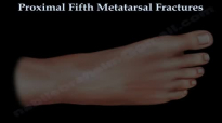 Proximal Fifth Metatarsal Fractures  Everything You Need To Know  Dr. Nabil Ebraheim