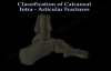 Calcaneal IntraArticular Fractures Essex Lopresti  Everything You Need To Know  Dr. Nabil Ebraheim