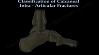 Calcaneal IntraArticular Fractures Essex Lopresti  Everything You Need To Know  Dr. Nabil Ebraheim