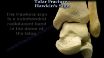 Talus Fracture , Hawkins Sign  Everything You Need To Know  Dr. Nabil Ebraheim