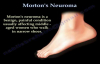 Mortons Neuroma  Everything You Need To Know  Dr. Nabil Ebraheim