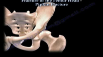 Fractures Of The Femur Head ,Pipkin Fracture  Everything You Need To Know  Dr. Nabil Ebraheim