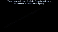 Ankle fracture , Supination External Rotation  Everything You Need To Know  Dr. Nabil Ebraheim