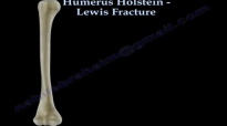 Humerus Holstein Lewis Fracture  Everything You Need To Know  Dr. Nabil Ebraheim