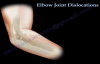 Elbow Dislocations  Everything You Need To Know  Dr. Nabil Ebraheim